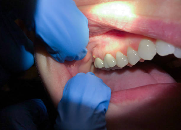 Best Emergency Treatment for Oral Infections in Woodbine, GA